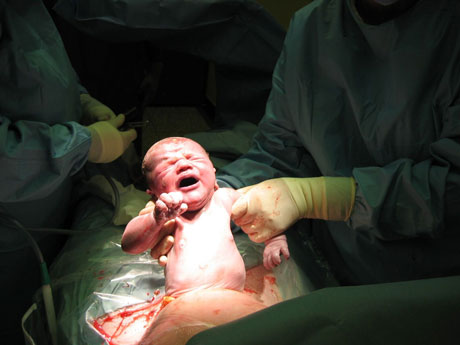 Foto från förlossning med kejsarsnitt