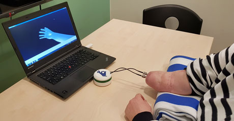 Foto av en amputerad arm som har en virtuell protes