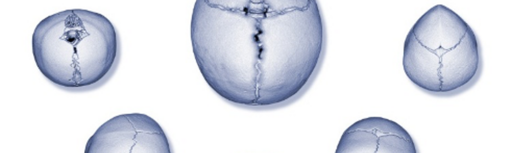 The central image shows a normal skull with open sutures and an oval head shape. 