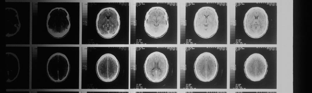 röntgenbilder hjärntumörer