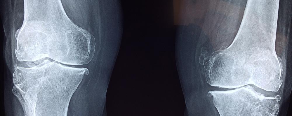 x ray image of knees 