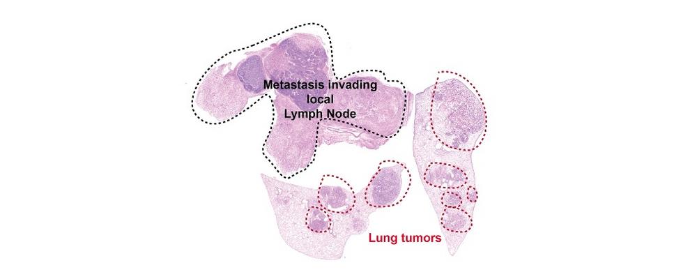 Mikroskopbild på lungcancer med lokala metastaser