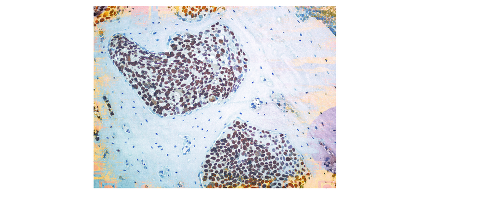 Immunohistochemistry image of LNCaP-19 bone metastases