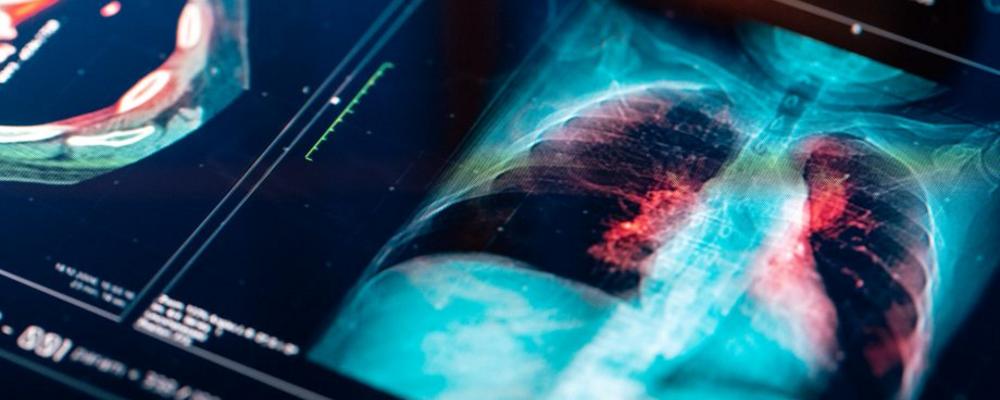 Röntgenbild på lungor
