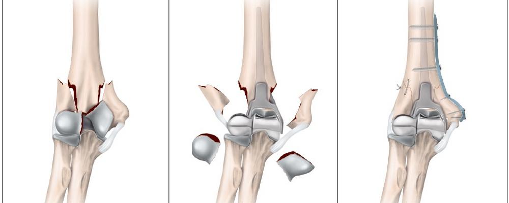 Illustration 27a-c in the thesis. Arthroplasty can be a treatment option for severe fractures of the upper or lower part of the upper arm. Read the full caption further down this page.