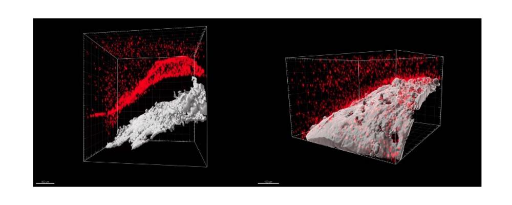 Bilder av tarmbiopsier där bakteriestora fluorescerande röda partiklar tillförts på epitelytan, sex år efter strålning mot bäckenområdet, tagna med avancerat mikroskop. För ytterligare beskrivning se längst ner i artikeln. 