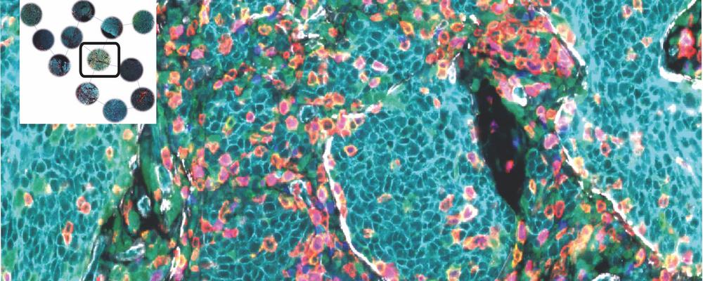 Cover illustration: Uveal melanoma metastasis patient biopsy depicting a highly multiplexed immune tumor microenvironment