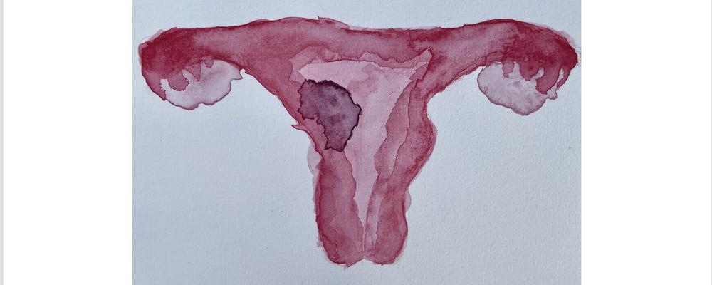 Akvarell av livmoder med tumör. 