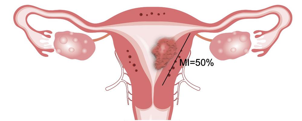 Uterus with endometrial tumor, marking for 50% myometrial infiltration (MI).