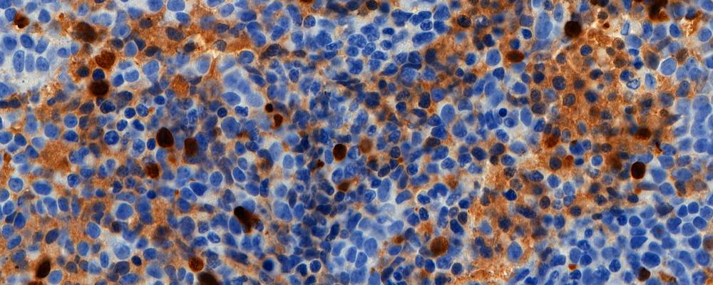 Omslagsillustration till avhandlingen: Visar högriskneuroblastomaceller som är infärgade för att illustrera en specifik celldöds mekanism (apoptos).