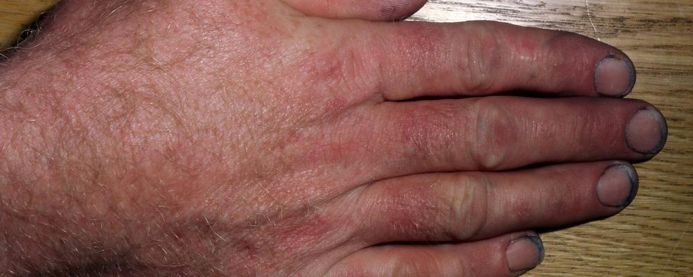 Picture of a hand with contact allergy showing.