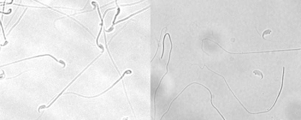 Mikroskopbilder på friska spermier och spermier där svansar och huvuden inte sitter ihop