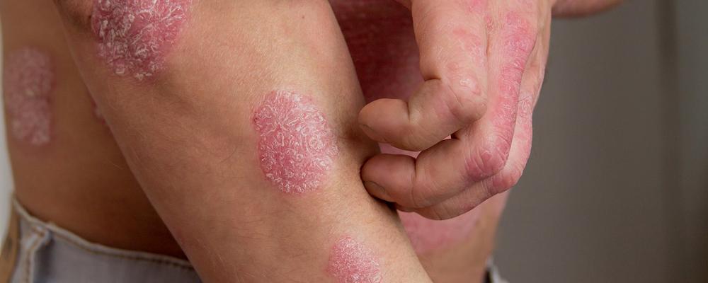 Mans armar i närbild, han kliar på sina hudutslag