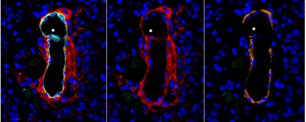 Immunofluorescensbild av ett blodkärl i en melanommetastas med en central pelare, ett typiskt tecken på intussusceptiv angiogenes. Cellkärnor visas i blått, endotel i turkos, kollagen IV i rött och glatt muskulatur/pericyter i orange.
