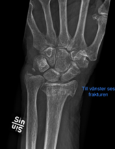 Röntgenbild radiusfraktur - vänster arm