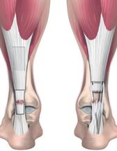 Figur 2 Kirurgisk behandling görs antingen med en förstärkning från vadmuskulaturen (till vänster) eller en sengraft från baksid