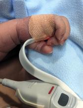Hand på bebis som genomgår pox-screening