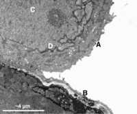 TEM image of tumor cell 