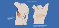 En illustration på en bröstrekonstruktion med lattimus dorsi, en av fyra bröstrekonstruktioner, se pdf nedan för alla illustrationerna