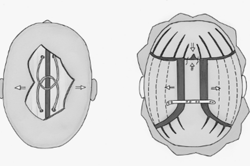 Schematic illustration of the two surgical techniques we use in sagittal synostosis