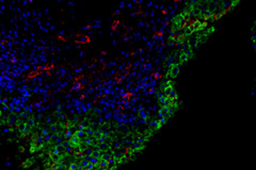 Aktiverade stromaceller infärgade i grönt i ett histologiskt preparat av ledkapsel från patient med ledgångsreumatism.