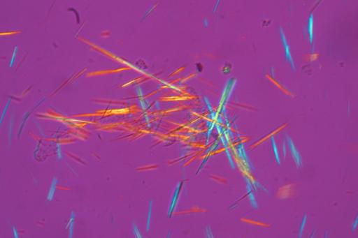 The picture shows uric acid crystals.