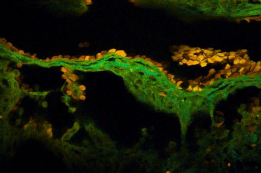 Bild från mikroskop på cancerceller i lymfkörtelvävnad.
