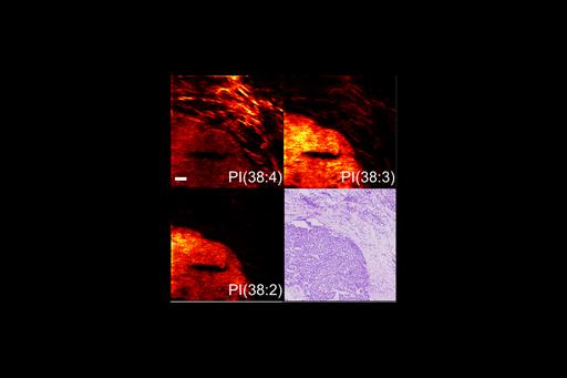 In situ lipid imaging in cancer with mass spectrometry