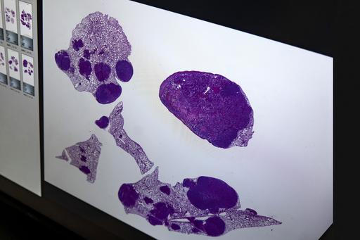 Exempel på vävnadsprov från olika delar av lunga med cancer de mörka partierna är tumörer.