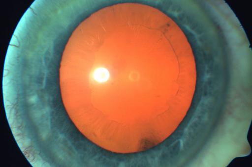 Patient with a long pupil with exfoliation (like a ring in the pupil)