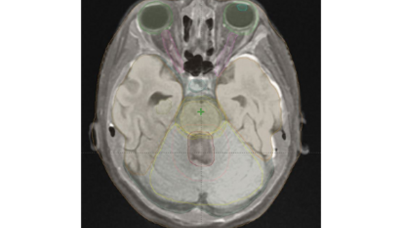 Röntgenbild på hjärnan