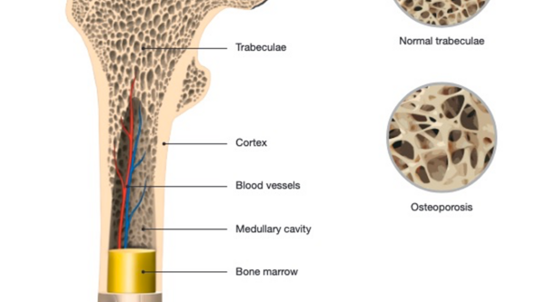 Normal benstruktur och den vid osteoporos