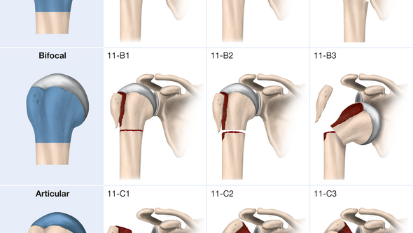 klassificering överarmsfrakturer