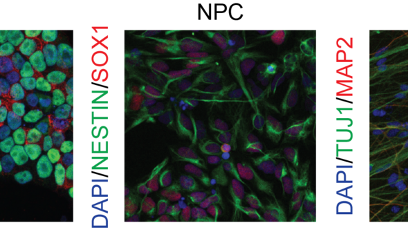 Tre bilder som visar markörer för pluripotens och neural differentiering i IPS-celler, neurala progenitorceller samt neuron.