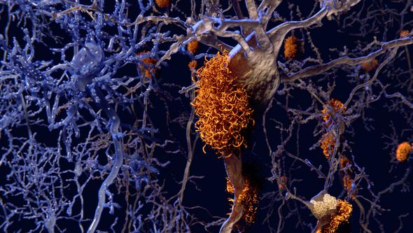 Illustration som visar neuroner ansatta av alzheimerplack. 