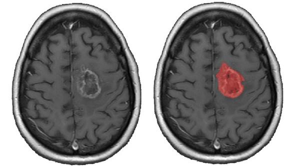 Exempel på en MR-bild av en hjärntumör (vänster) och samma bild med en automatiskt genererad segmentering av tumören i rött (hög