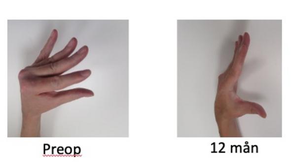 Bilden visar en patients öppningsförmåga av handen före och 12 månader efter operation.