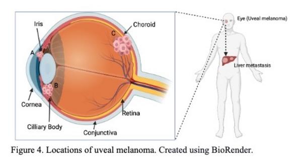 Locations of uveal melanoma. Created using BioRender.