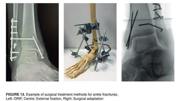 Exempel på kirurgiska metoder för behandling av fotledsfrakturer. Vänster: Plattfixation Mitten: Extern fixation Höger: Adaptati