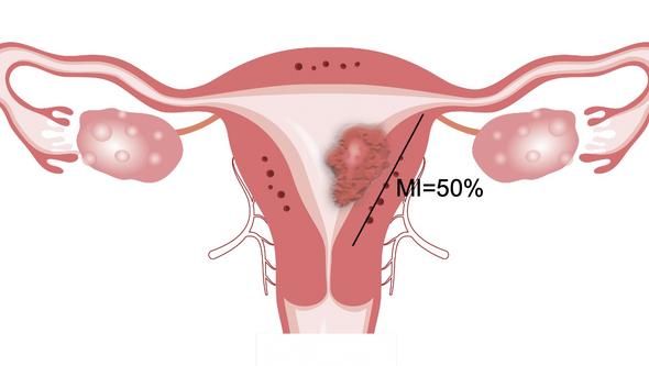 Teckning av livmoder med tumör. Illustration Jan Funke Figur 5 sidan 21 I avhandlingen.