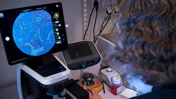 Mattias Svensson vid mikroskop med vävnadsprov som visar följder av ledgångsreumatism.