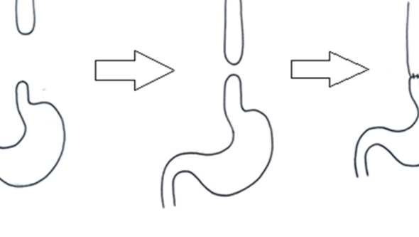 Tecknad magsäck hos barn med EA