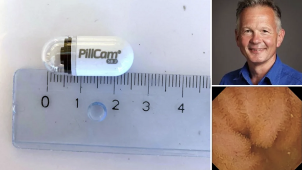 Bildmontage: 1. Den pyttelilla kameran filmar matsmältningssystemet från insidan. Porträttbild på Thomas de Lange 