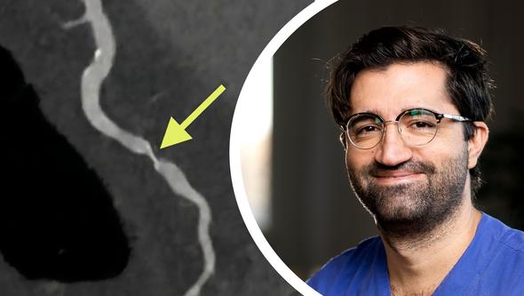 CT coronary artery narrowing beside portrait of a doctor