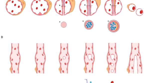 Figur 1. Schematisk översikt av intussusceptiv angiogenes. (A) Tvärsnitt av ett blodkärl som genomgår intussusceptiv angiogenes,